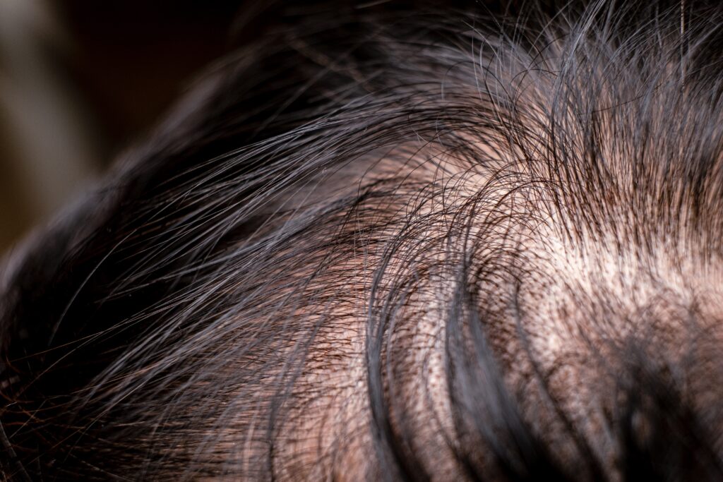 adult man hair loss, close up